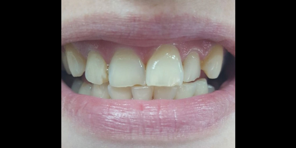  Косметическая (художественная) реставрация 2-х центральных зубов