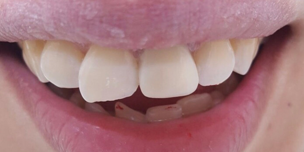  Косметическая (художественная) реставрация фронтального зуба методом прямого винирования