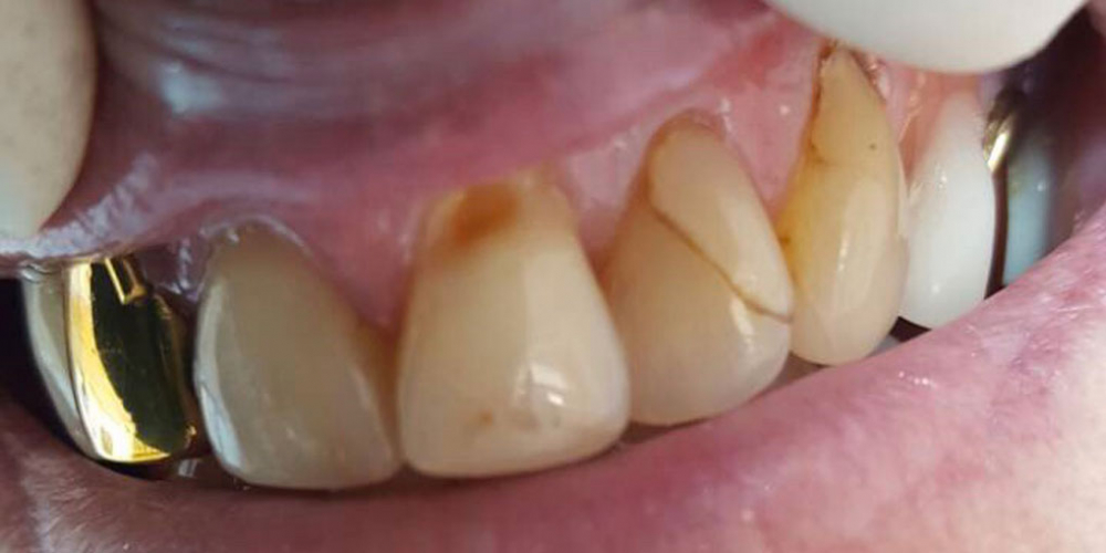  Реставрация центральных зубов без протезирования