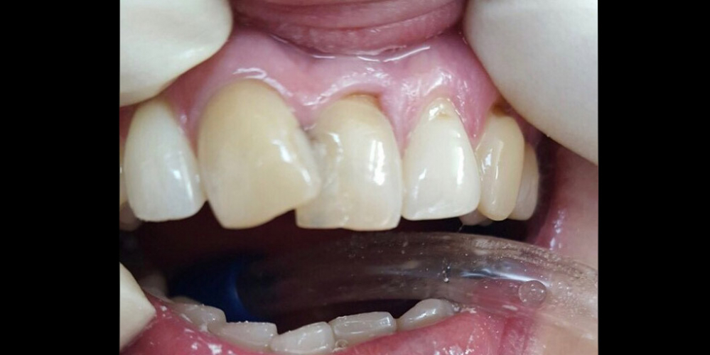  Фото художественной (косметической) реставрации фронтальных зубов
