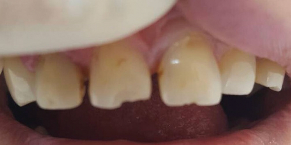  Устранение сколов и диастемы между передними зубами композитными материалами