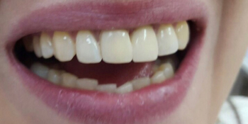 Фото художественной (косметической) реставрации фронтальных зубов фото после лечения